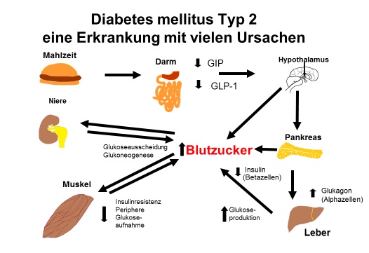 Was ist Diabetes mellitus Typ 2? - diabetes-news : diabetes-news